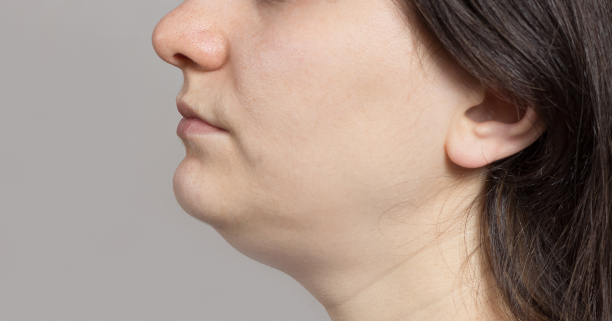 BIOGEL «Стройность» применяют для коррекции брылей и второго подбородка при наличии жирового компонента, помогая деликатно уменьшить объём и сделать контур лица более чётким.