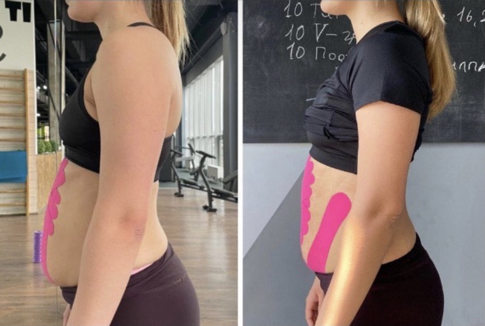 Кейс из личной практики. Собирались поработать с девушкой над областью живота, но это оказался не жир, а слабые мышцы живота + диастаз