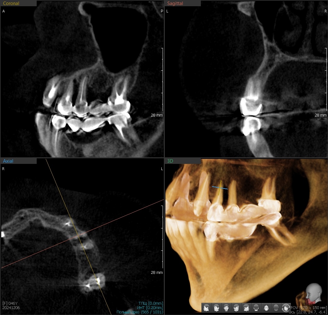 КТ до вмешательства