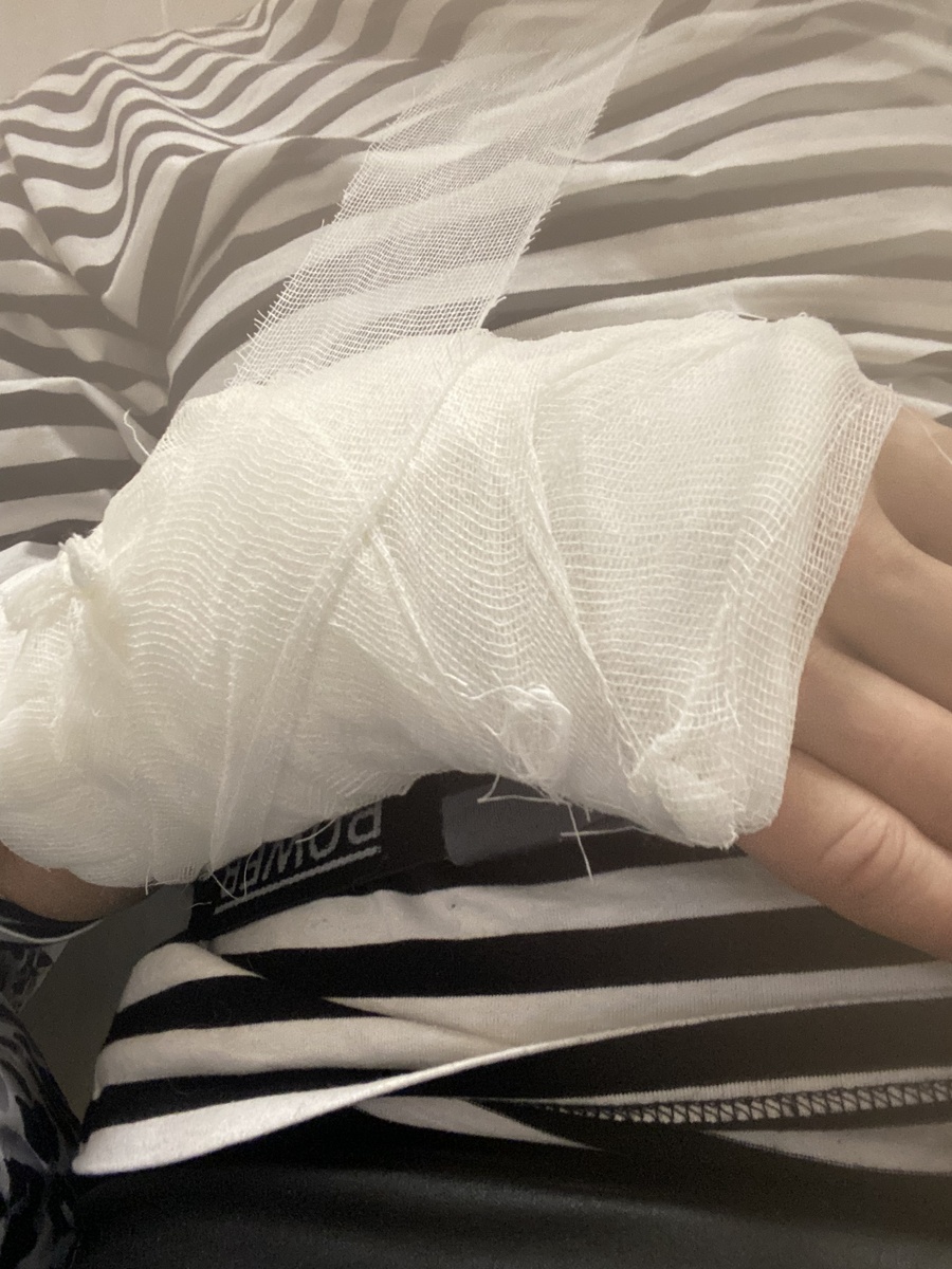 Закрытый перелом