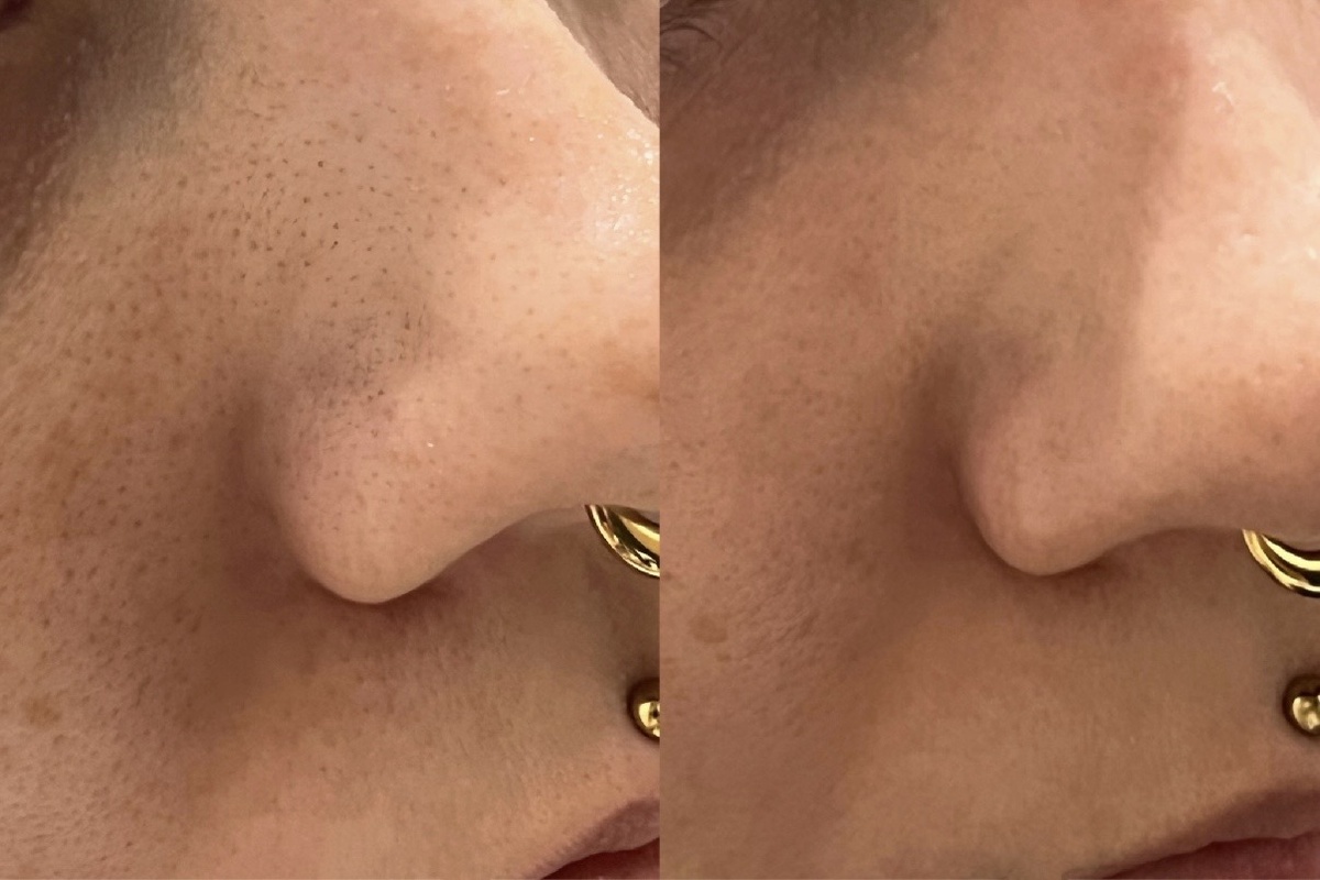 Это результат ретинола за неделю 