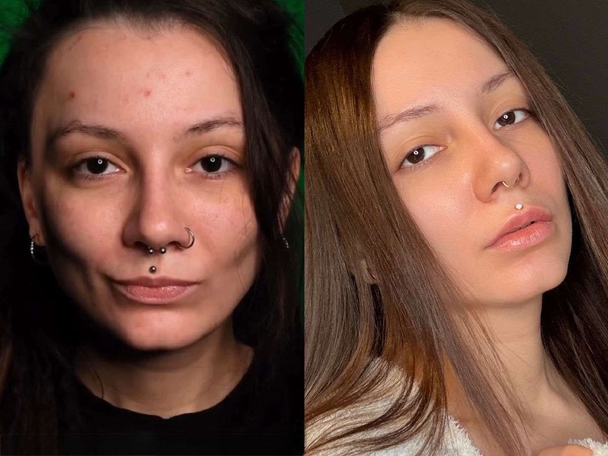 Я безумно счастлива, что избавилась от бесконечных высыпаний