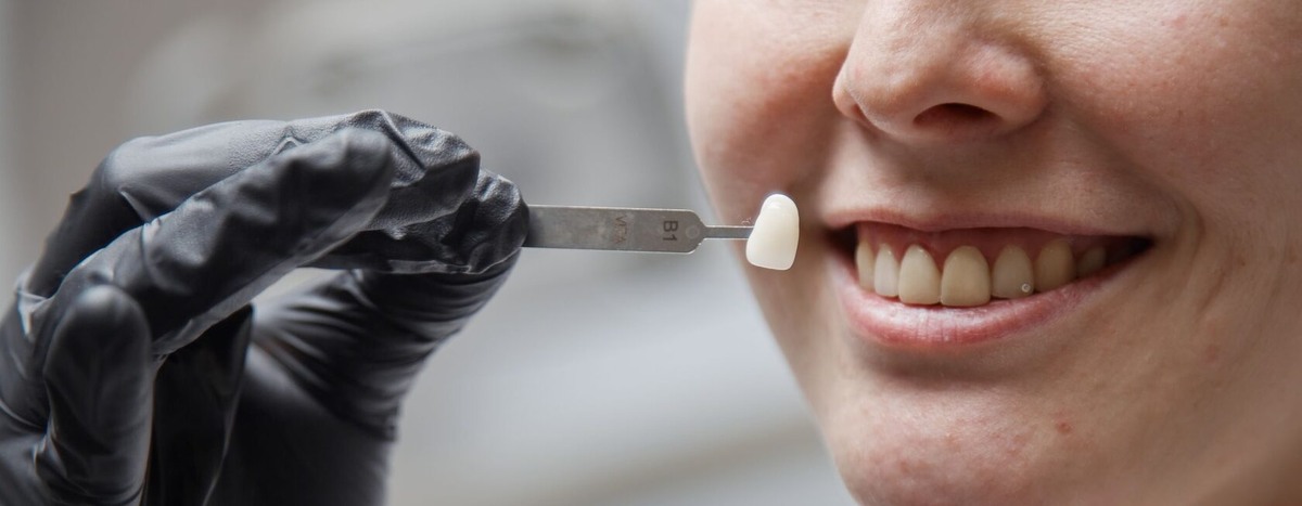 Реставрации и виниры в «Дант»