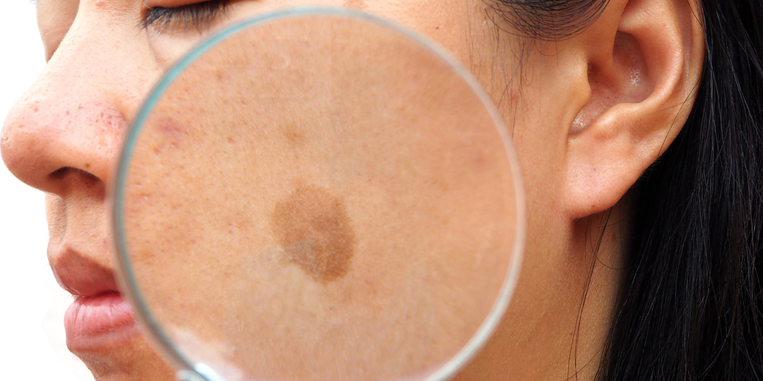 Пигментное пятно стало темнее — какие обследования назначают