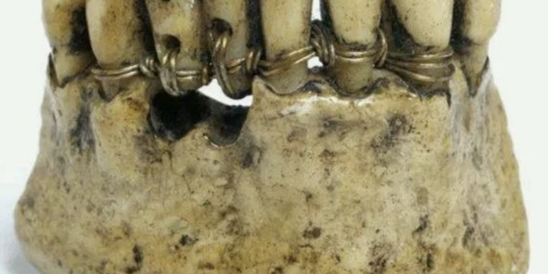 Когда приходит срок менять коронку и от чего это зависит