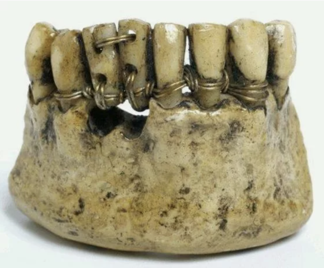 Вот этот протез я бы поменял уже, но поздно!