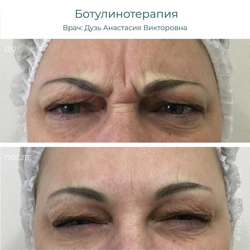 Результат ботокс-терапии (фото принадлежит Дузь Анастасии Викторовне)