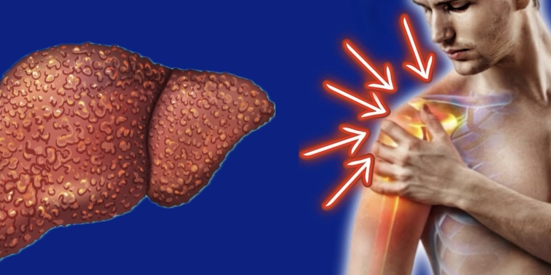 Боль в правом плече: когда причина не в суставах, а в печени