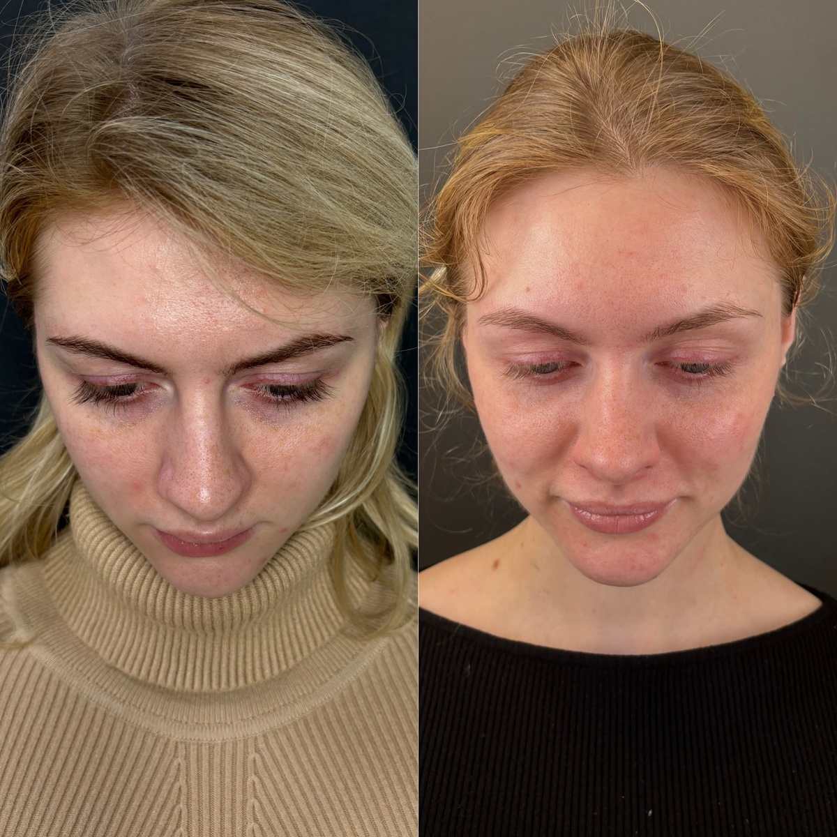 Ринопластика: 1 год после операции (слева - до, справа - после). Хирург Остринская Т.В.