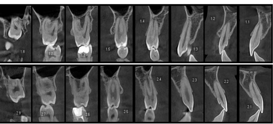 КЛКТ. Листайте галерею, чтобы увидеть другие фотографии диагностик перед ортодонтическим лечением..