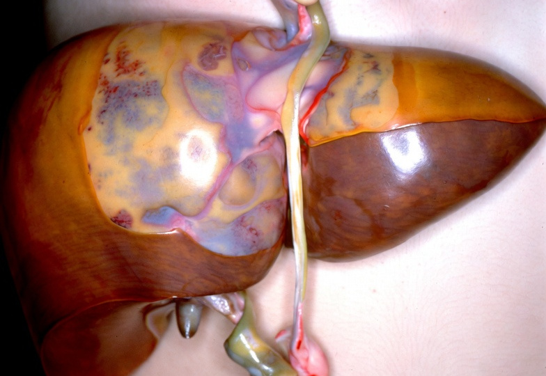 Через сколько будет цирроз печени если пить только по выходным?