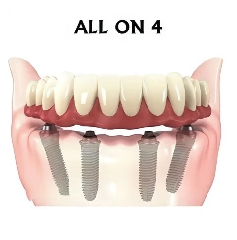 Имплантация All-on-4