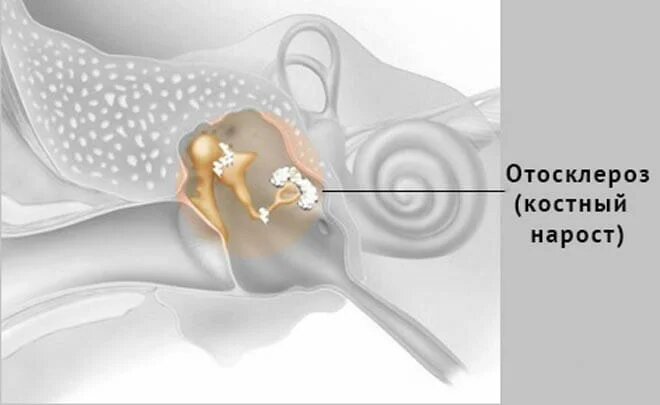 Частая причина шума в ушах после 50