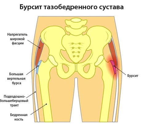 Бурсит тазобедренного сустава. Что это? Что поможет? 