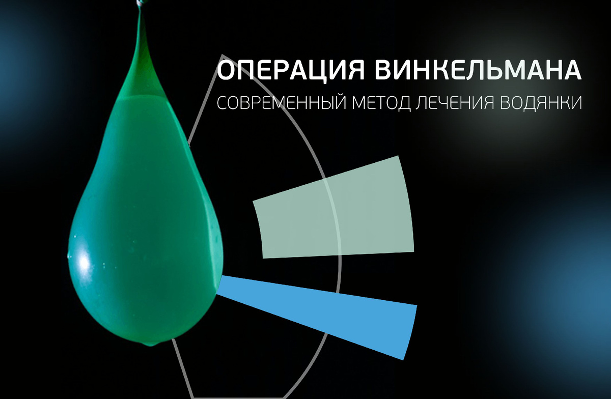 Операция Винкельмана: когда водянку яичка действительно нужно оперировать и почему «само не рассосётся»