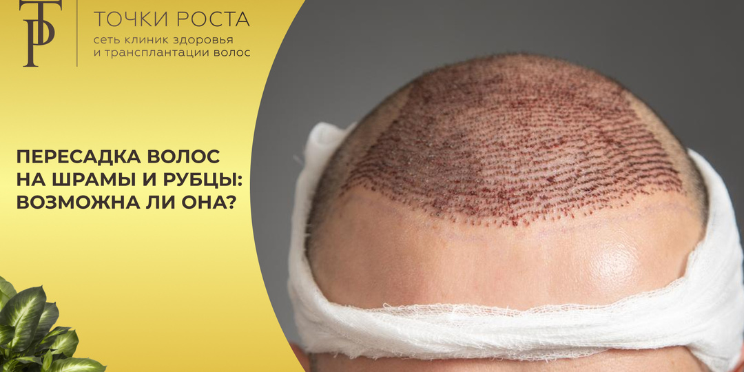 Пересадка волос на шрамы и рубцы: возможна ли она?