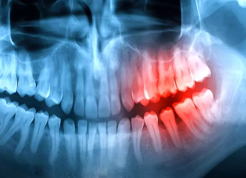    Рентгеновский снимок челюсти человека. Фото: СоцСети.