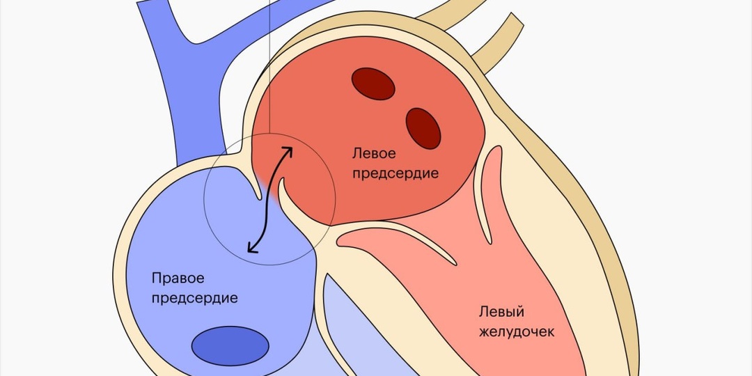 🏥 Инсульт в молодом возрасте или череда инсультов у одного пациента: в чем причина