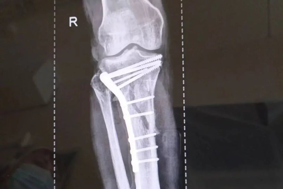    Липецкие врачи спасли ноги мужчины после страшного ДТП