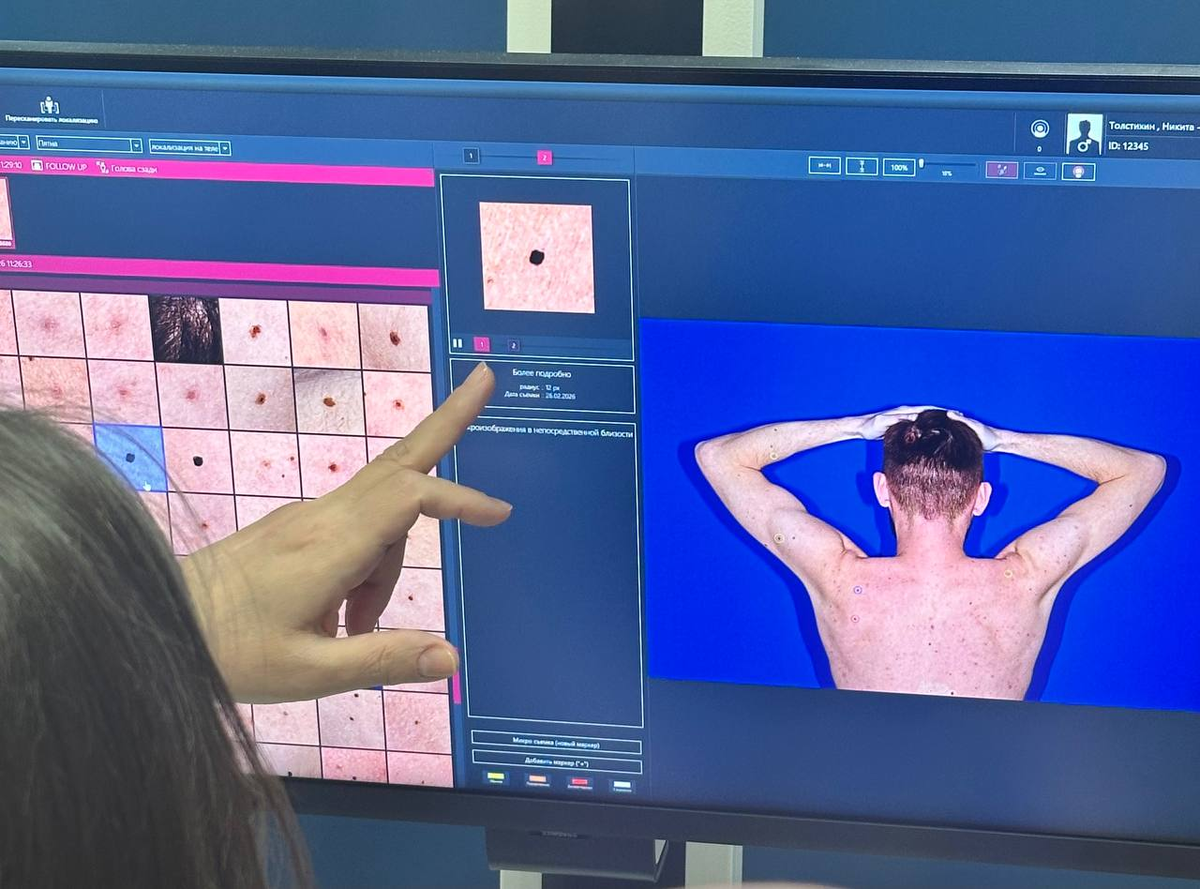 Так выглядит этот самый "БАНК" ваших родинок. Он хранится годами для того, чтобы каждую из них можно было отследить в динамике