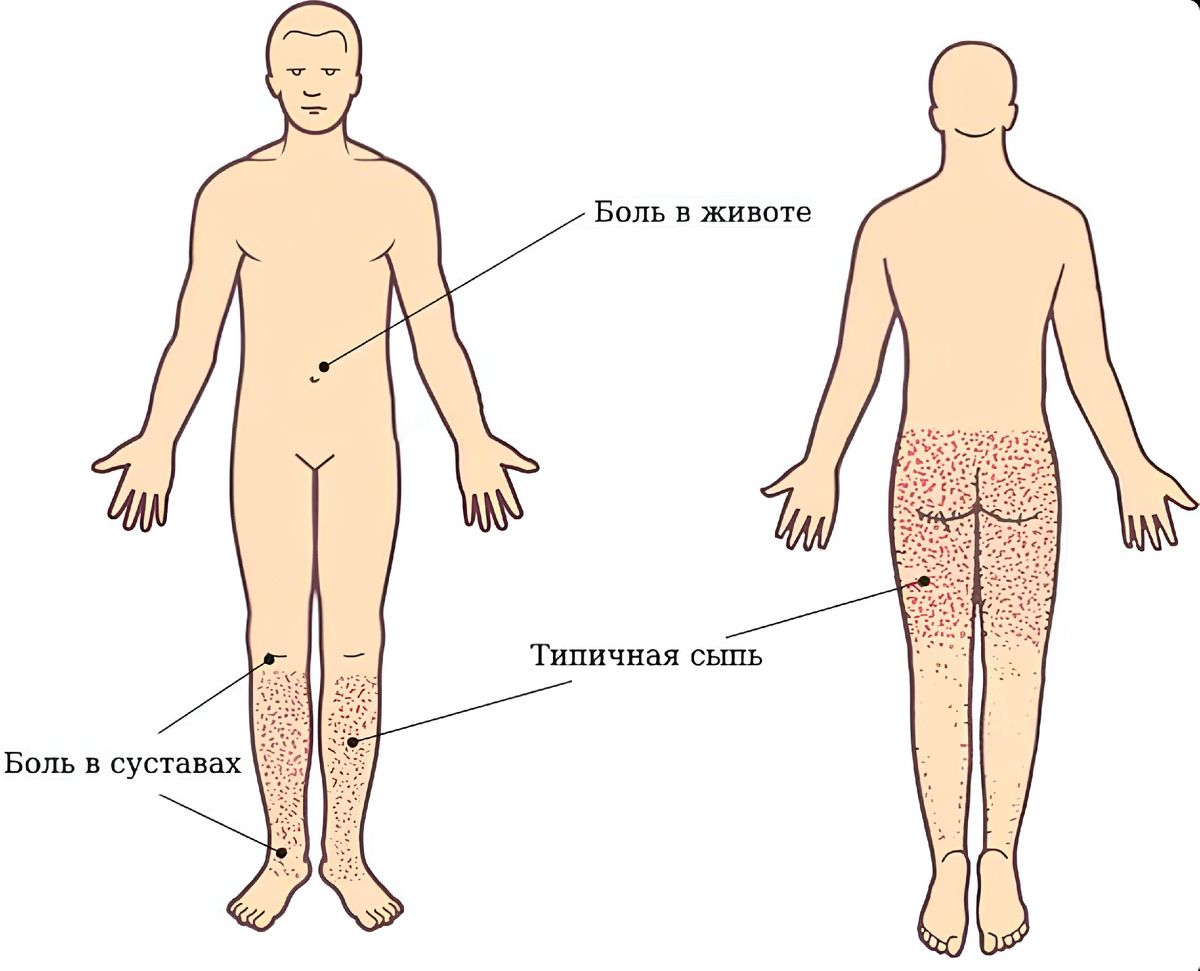 Симптомы геморрагического васкулита