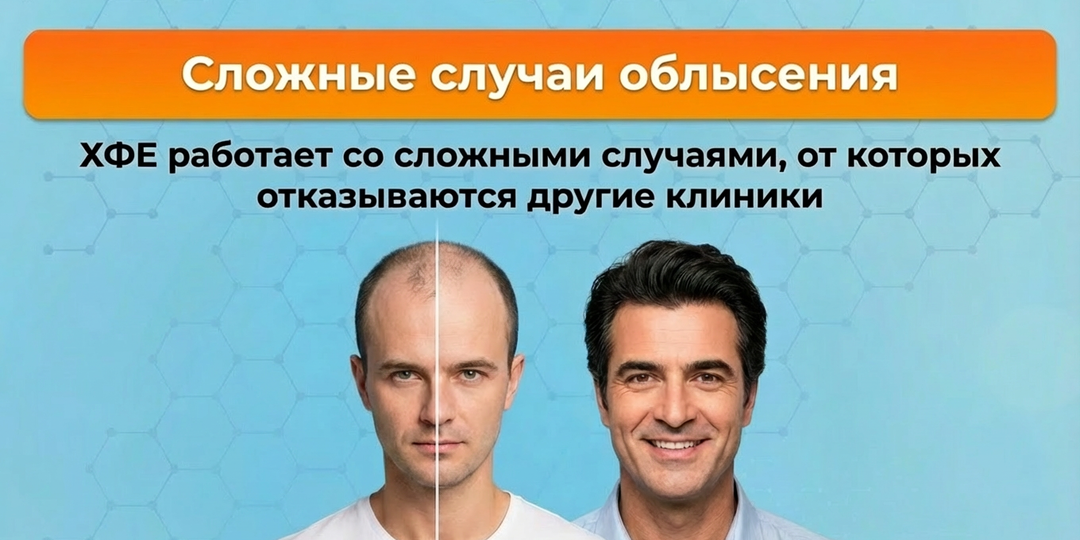 Сложные случаи облысения: ХФЕ работает со сложными случаями, от которых отказываются другие клиники