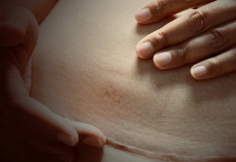 Восстановление тканей живота с помощью телески запускает цепочку позитивных изменений во всём организме