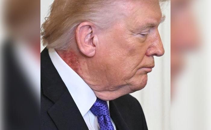 Красное пятно на шее Трампа. Фото © Х / Globe Eye News