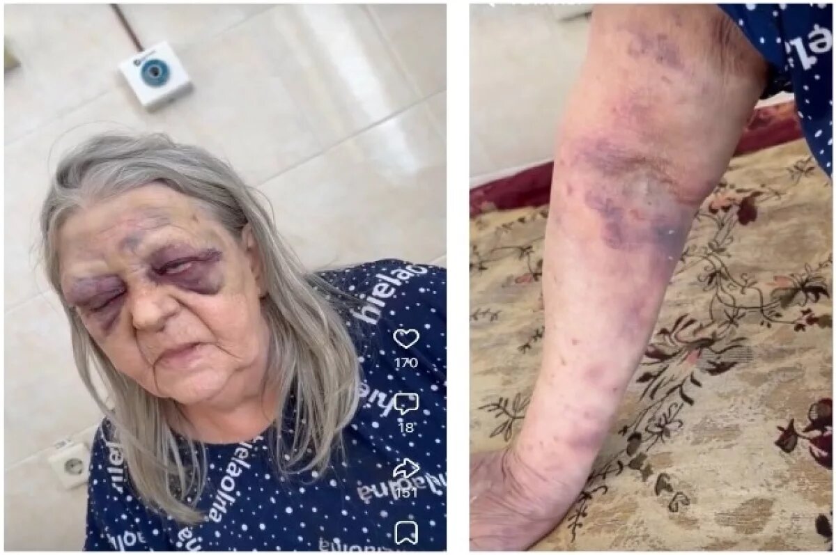    Избитую в Мариинской больнице пенсионерку перевезут в Красноярск