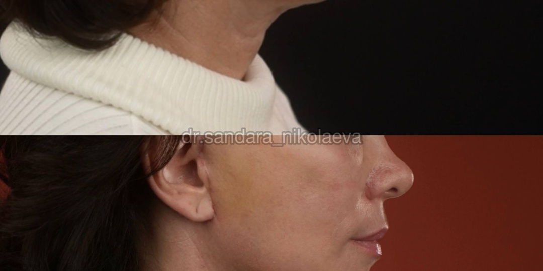 1 месяц после фейслифтинга, лобно-височного лифтинга