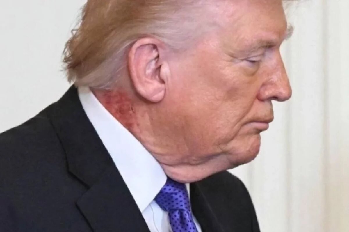    Нервы из-за Ирана или старая болезнь: откуда у Трампа странный след на шее