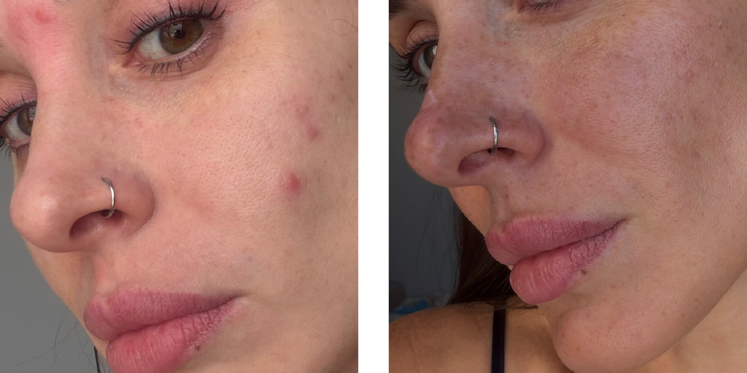 То, что стыдно показать. Но просто невозможно молчать. Моя история кожи, которая по глупости может случиться у всех