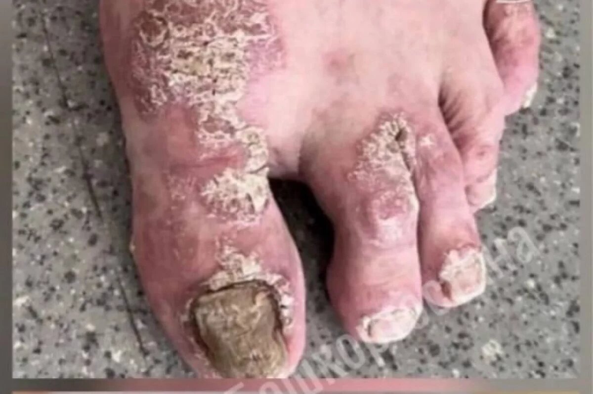    Больному тяжелой формой артрита в Уфе помогла генно-инженерная терапия