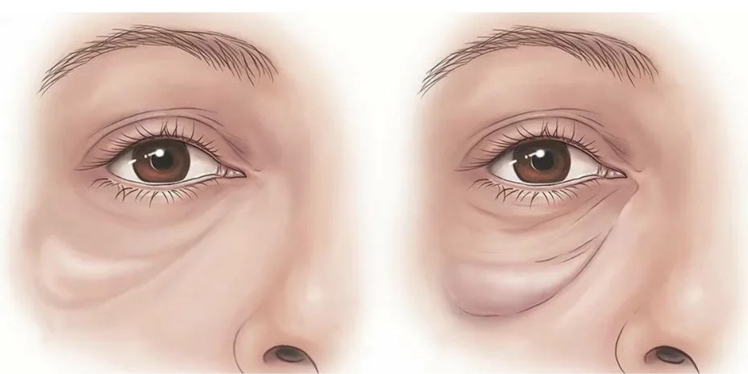 4 минуты и глаза откроются, веки поднимутся, даже  суфы под глазами уйдут
