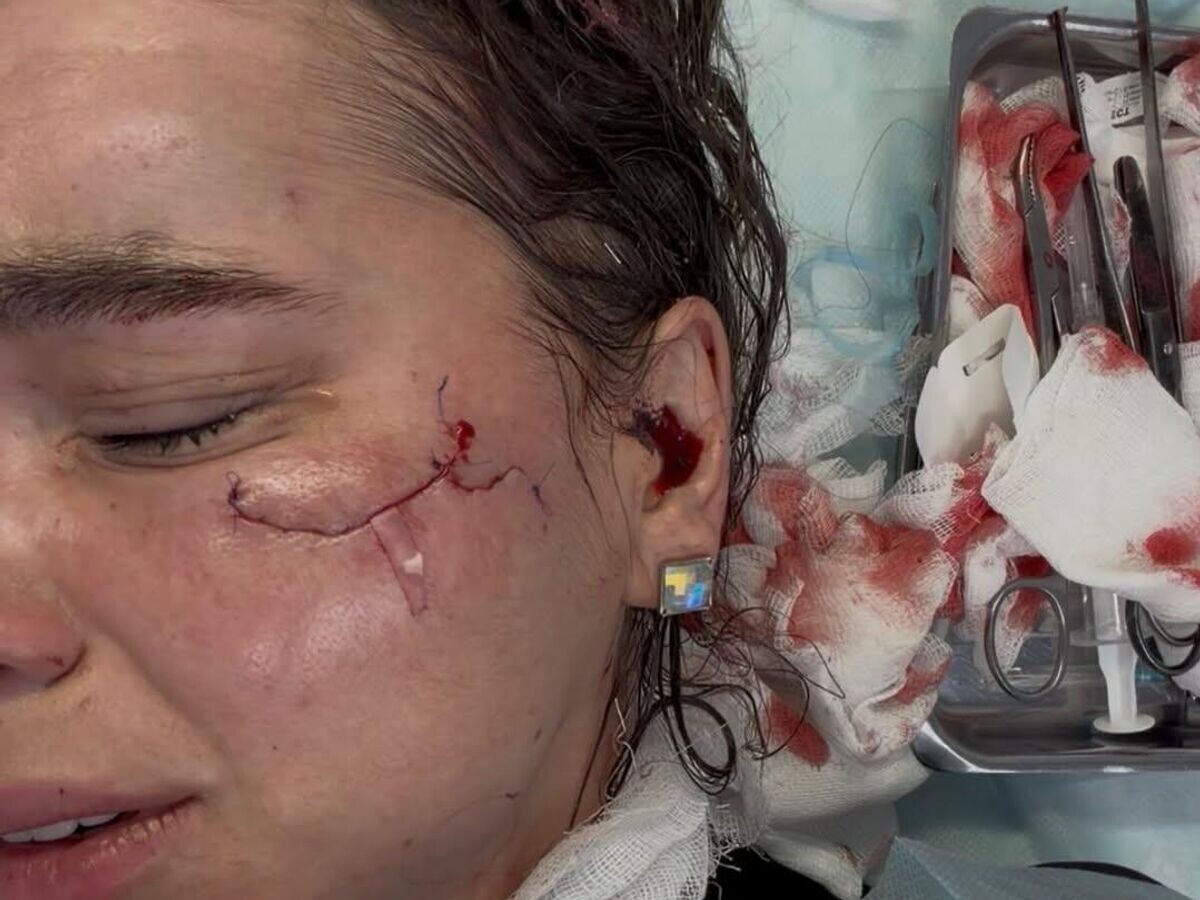    Победительница конкурса красоты из Кирова Надежда Шустова после удара бокалом | © Фото : соцсети Надежды Шустовой