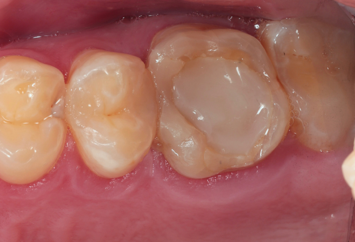 Зуб 2.6 под пломбой