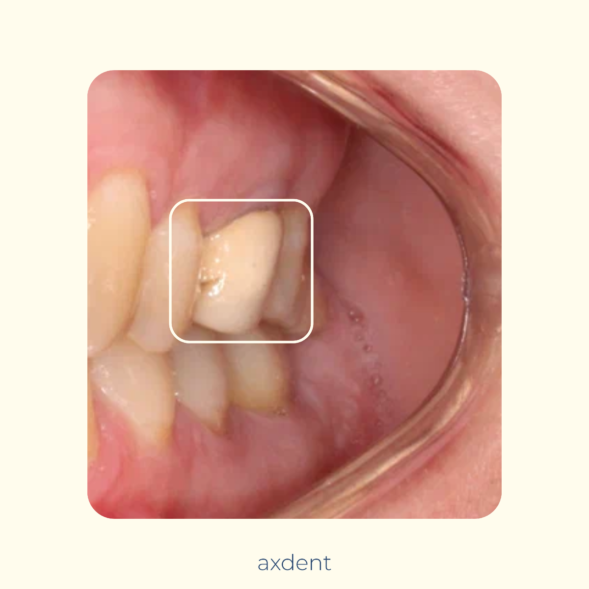 Коронка с нарушенным прилеганием