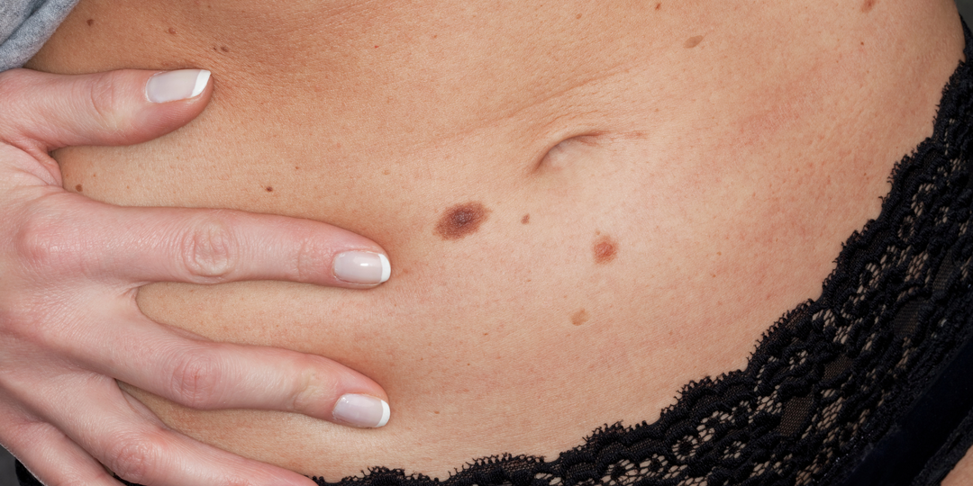 6 изменений на коже, которые могут расти годами без боли