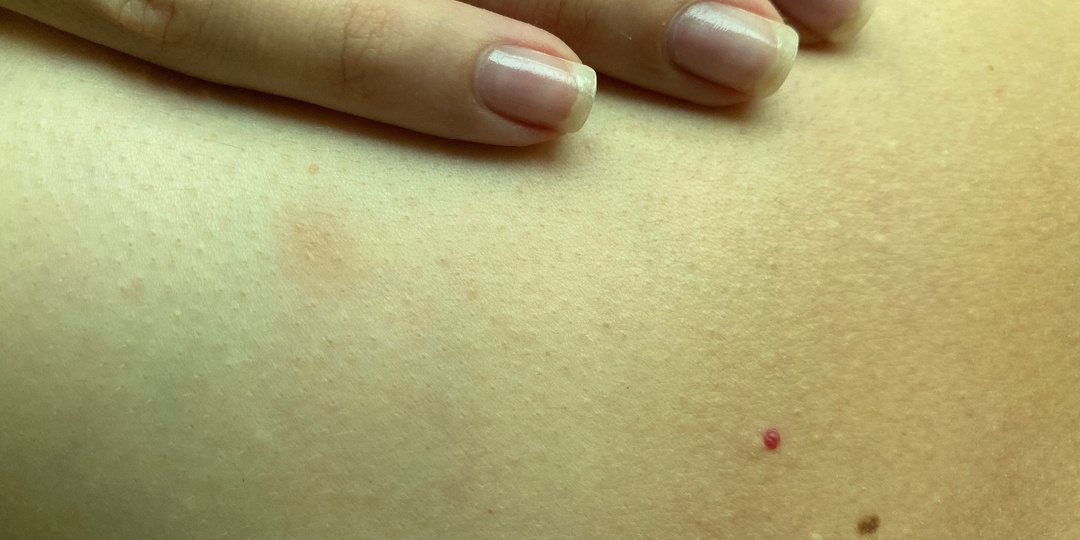 7 признаков на коже груди, которые требуют контроля