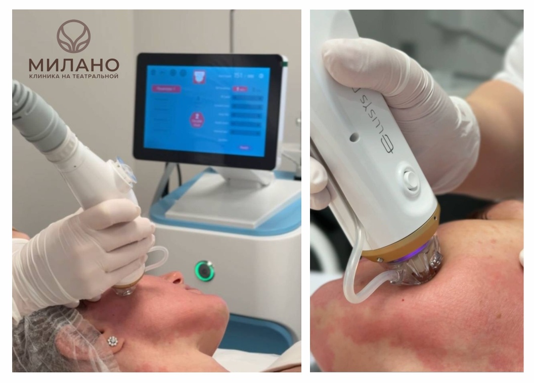 Игольчатый RF-лифтинг в клинике Милано