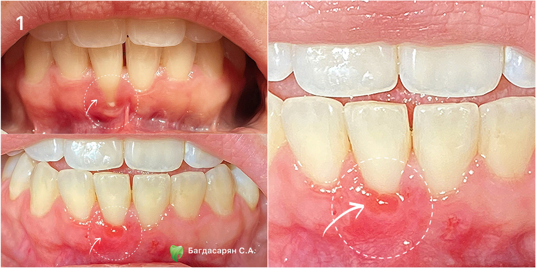 Рецессия десны