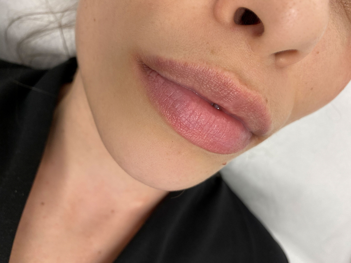 Свои губы до ПМ, форма размыта, контур не четкий, гранулы Фордайса на стыке верхней губы, объем хороший 