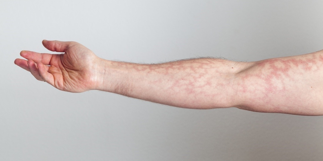 Кожа стала чувствительной и кровит — что исключают врачи