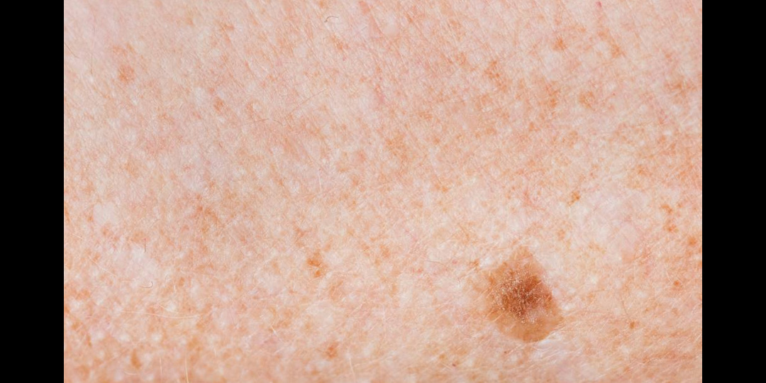 Необычная корочка, которая не заживает — когда это опасно