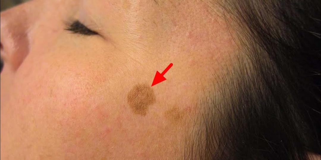 Кожа стала резко пигментированной — какие обследования проводят