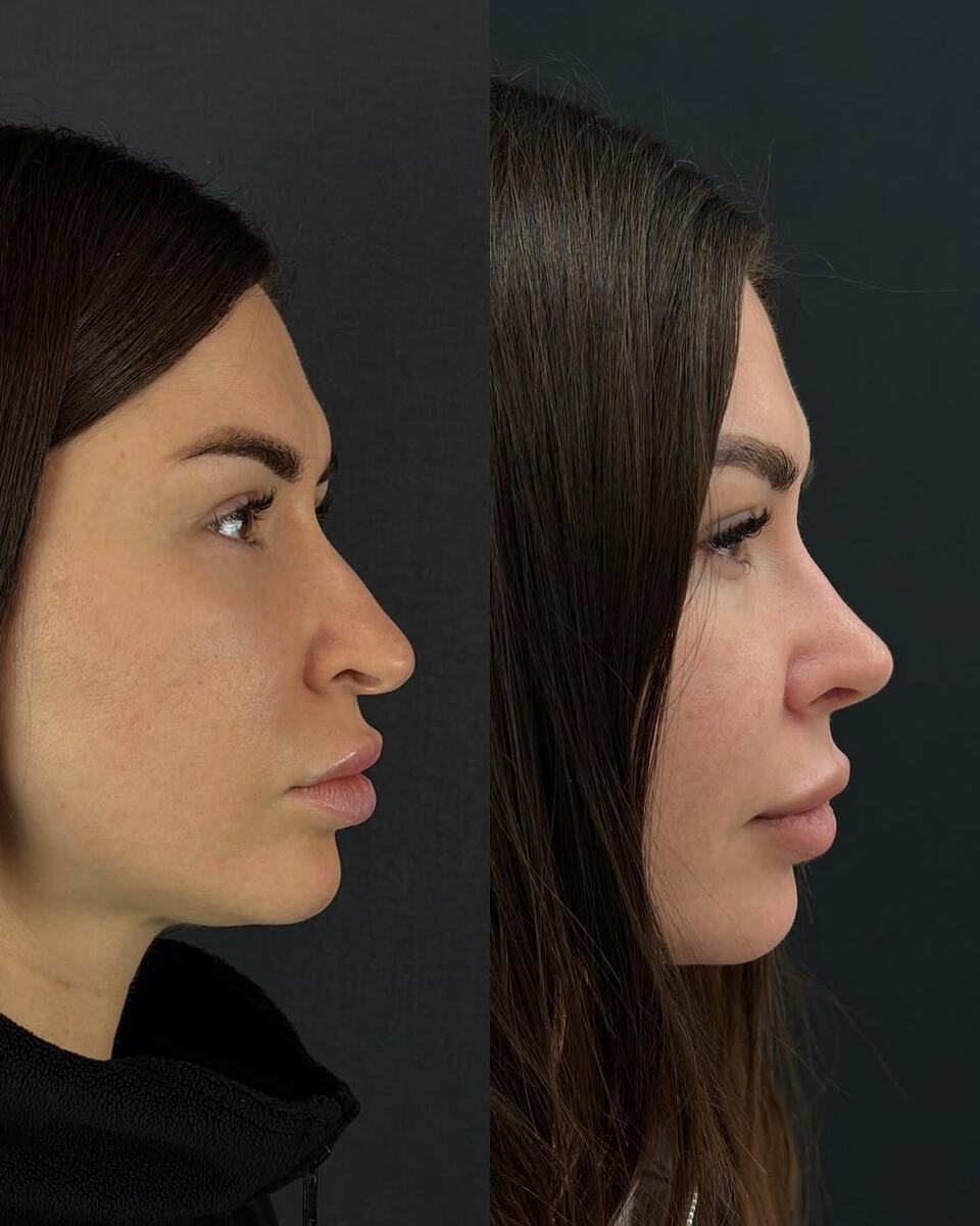 Результат ринопластики в исполнении Дирксена Петра Викторовича