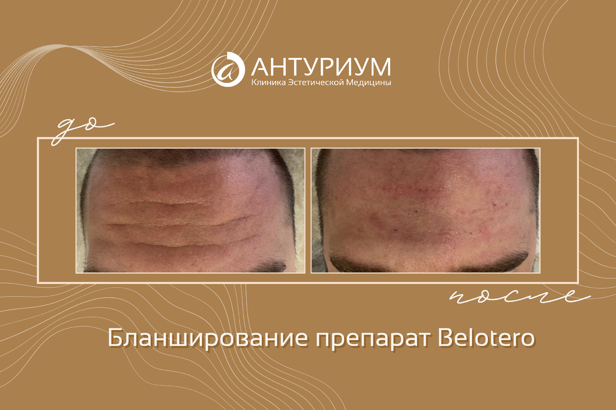 Бланширование 