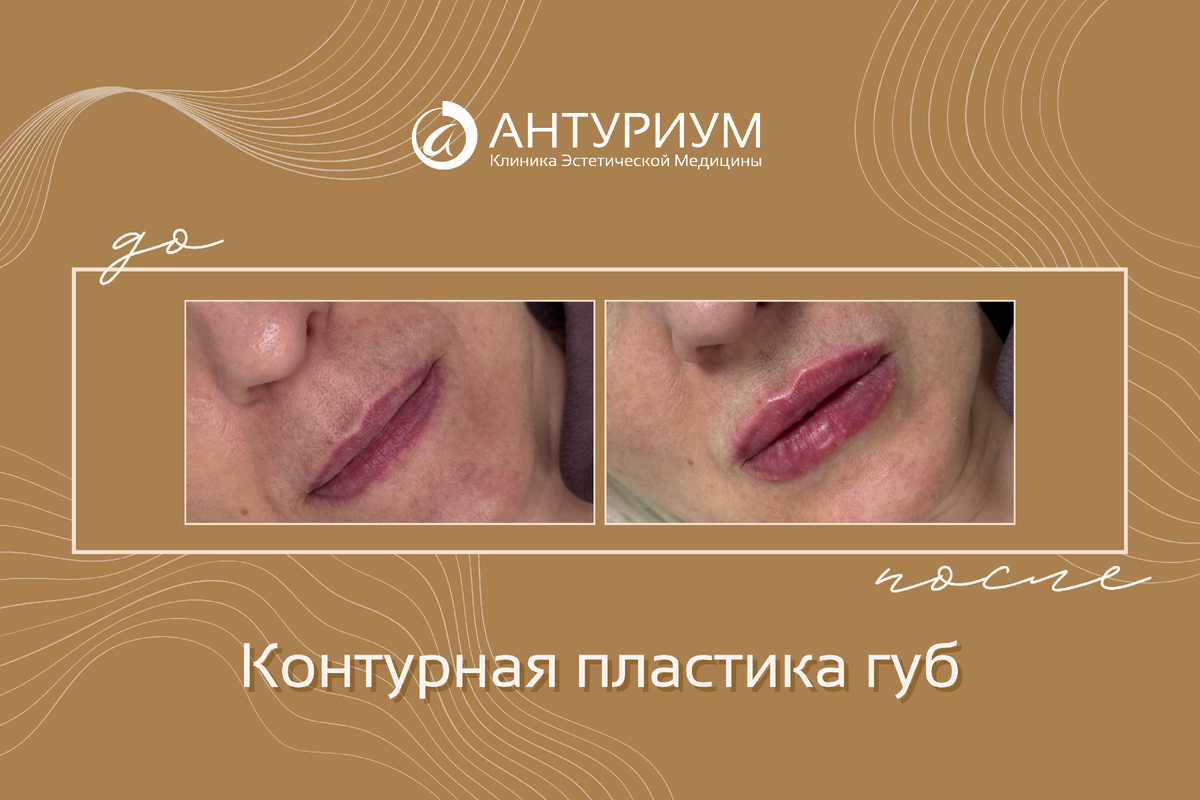 Контурная пластика губ
