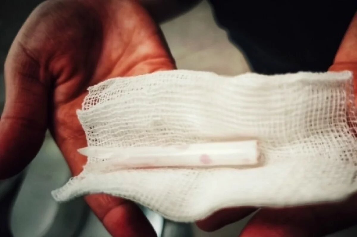    Ижевские врачи удалили из бедренной вены пациента инородный предмет