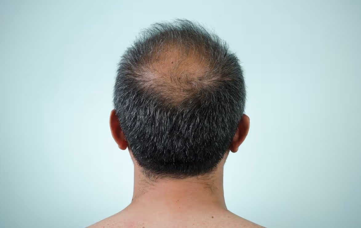    Три типа клеток, одна чашка Петри и немного терпения — так выглядит потенциальное будущее борьбы с облысением. Источник изображения: sciencealert.com